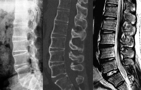 The Andersson Lesion In Ankylosing Spondylitis Bone And Joint