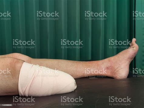 Below Knee Amputation Bandaging For Bk Prosthesis Stock Photo
