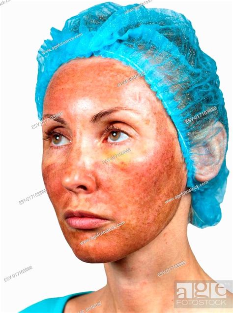 Cosmetology Skin Condition After Chemical Peeling Tca Foreshortening