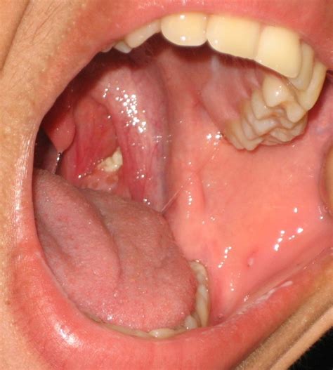 File Tonsillolith In Mouth Wikimedia Commons