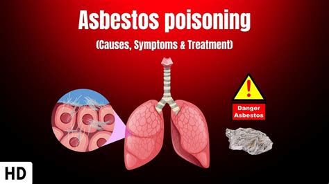 Asbestos Poisoning Causes Symptoms And Treatment Youtube