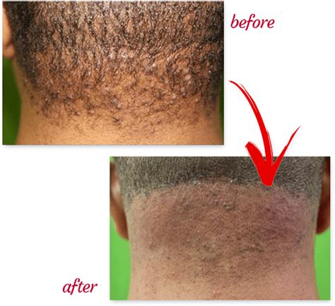 Dr U Acne Keloidalis Nuchae Clinic For The Best Treatments Of Akn Or