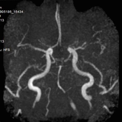 Pdf Bilateral Anterior İnferior Cerebellarartery Infarction