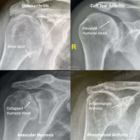 Shoulder Joint Arthritis Dr Pant Sydney Shoulder Unit