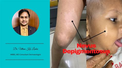 Nevus Depigmentosus White Birth Mark And Its Treatment Skin Me Safed