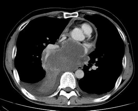 Mediastinal Lymph Node Metastasis Of Renal Cell Carcinoma A Case Report