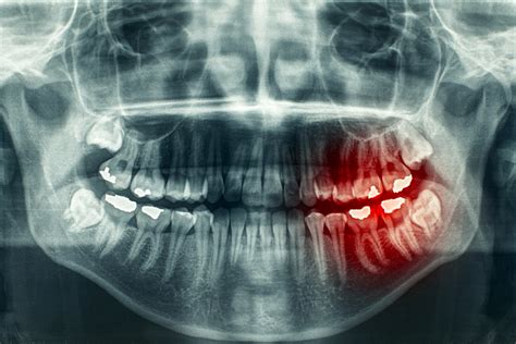 Answers To Concerns About Dental X Ray Radiation Pella Ia