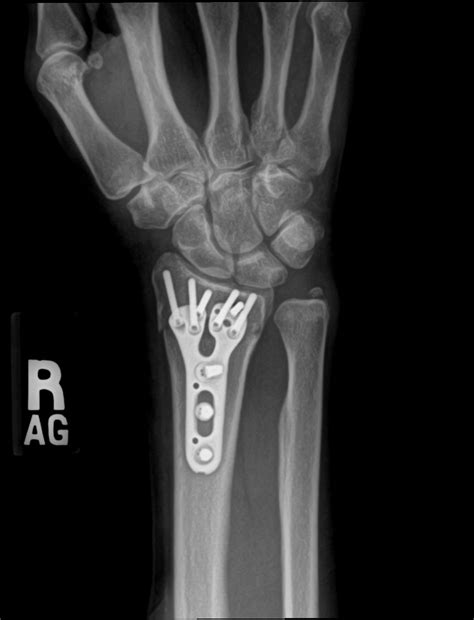 Broken Wrist Treatment In Raleigh Nc John Erickson Md