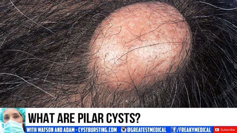 Pilar Cysts Scalp Cysts Cyst Pops And Dermatology Youtube