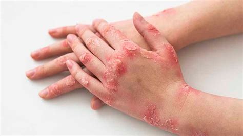 10 Strategies To Reduce Eczema Itchy Red Skin The Wellness Corner