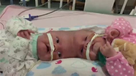 Rare Conjoined Twins Born Fused By Their Skulls Successfully Separated After 11 Hour Operation