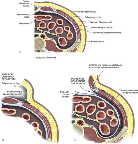 Open Repair Of Parastomal Hernias Plastic Surgery Key