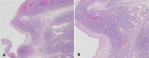 Hiv Associated Benign Lymphoepithelial Cysts Of The Parotid Glands