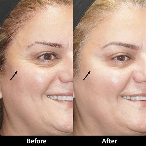 Botox Before And After Pictures Med Spa In Encino Ca