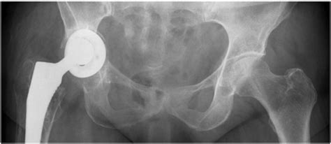 Acetabular Component Anteversion In Primary And Revision Total Hip