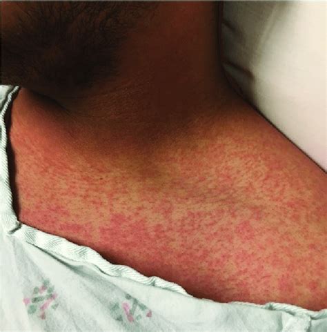 Typical Maculopapular Rash Of Zika Virus Photograph Courtesy Of Dr