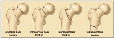 Subcapital Femoral Neck Fracture