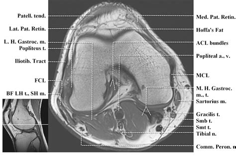 These are essential structures to evaluate in routine assessment of the knee on mri. Knee Muscle Anatomy Mri - knee anatomy | MRI knee coronal anatomy | free cross sectional anatomy ...