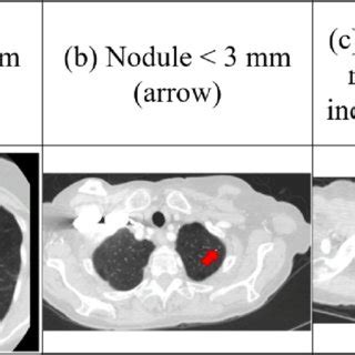 The Malignant And Benign Lung Nodules Of Computed Tomography CT