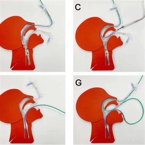 Pdf Conversion Of An Oral To Nasal Intubation In Difficult Nasal