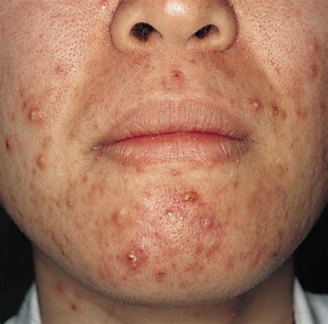 Medical Pictures Info Pustules