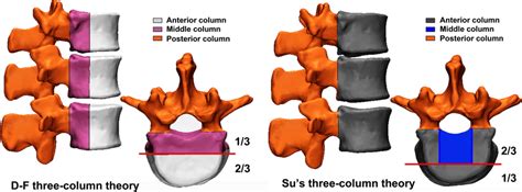 The Pattern Diagram Of Three Column Spinal Theory D F Three Column