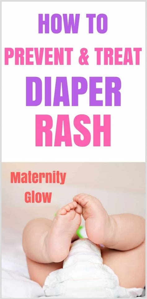 The Ultimate Guide To Preventing And Treating Diaper Rash
