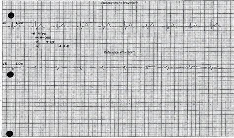 Less Phosphorus More Problems Hypophosphatemia Induced Polymorphic Ventricular Tachycardia In