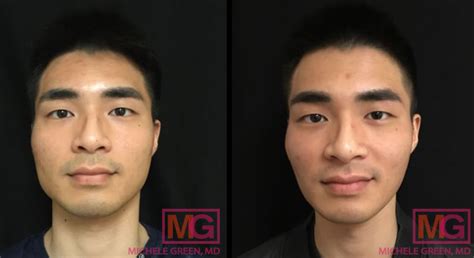 Non Surgical Jaw Reduction With Botox And Botox Masseter Muscles Nyc