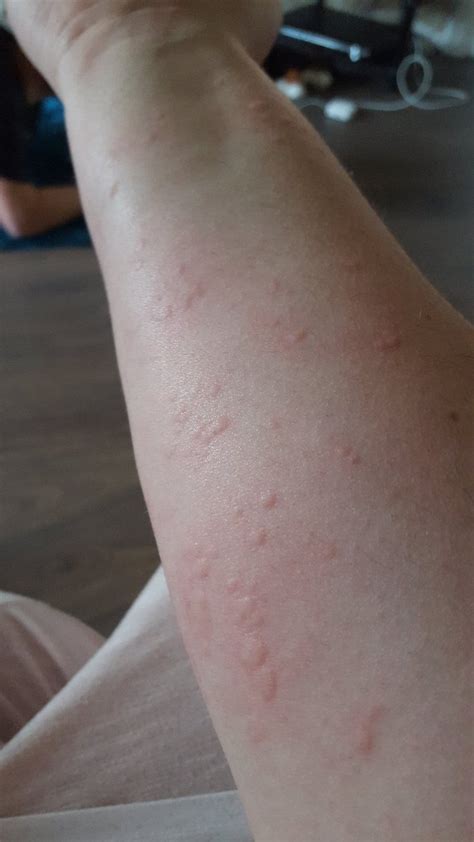 Can Humans Get A Rash From Dogs