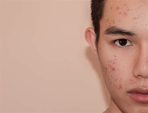 Common Mens Skin Issues Decoded By Skin Specialists And Professionals