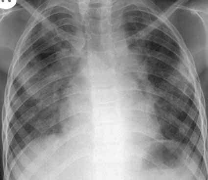 Pneumonia is a common lung infection caused by bacteria or viruses that can lead to mild to severe illness. pneumonia | Medical Pictures Info - Health Definitions Photos