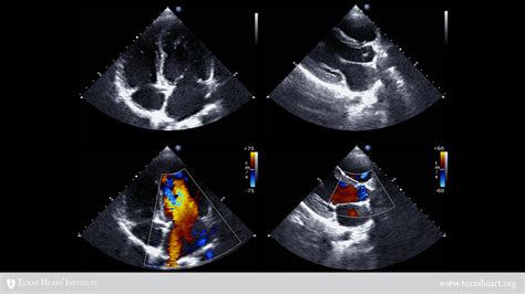 Intravascular Ultrasound Echocardiography Texas Heart Institute