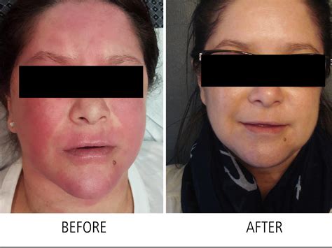 Is Rosacea Leaving You Red Faced Lasermed Laser Clinic And Facial