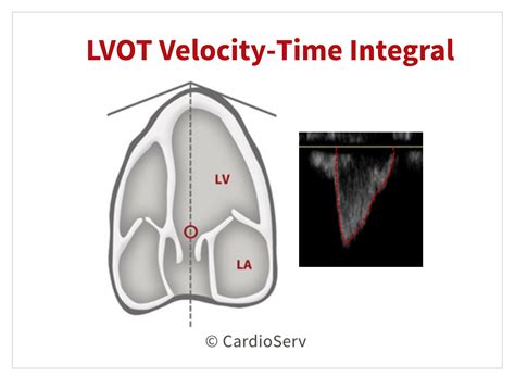 Aortic Stenosis Breaking Down The Continuity Equation Cardioserv