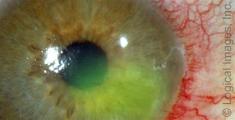 Patient With Recurring Sharp Pain In Left Eye Journal Of Urgent Care