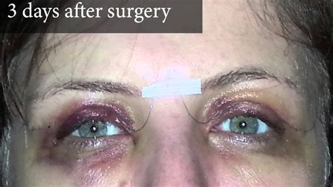 upper eyelid surgery post op