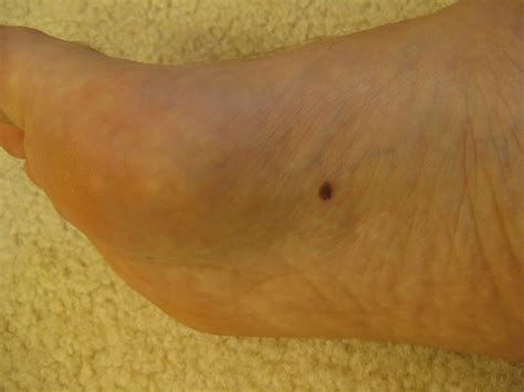 Skin Cancer On Foot Skin Check Houston Podiatrist Tanglewood Foot