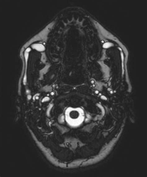 Idiopathic Bilateral Sialectasis Of Stensens Ducts Eurorad
