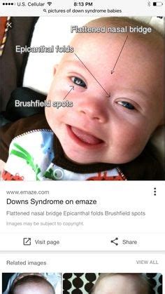 The general appearance is inspected for plethora (maternofetal transfusion), macrosomia (maternal diabetes), and lethargy or extreme irritability (sepsis or infection) and for any dysmorphic features such as macroglossia (hypothyroidism) and flat nasal bridge or bilateral epicanthal folds (down syndrome). Flat Nasal Bridge And Epicanthal Folds : Clincal Features ...