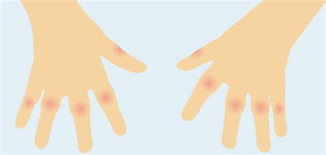 Rheumatoid Nodules In Rheumatoid Arthritis Ra Nras