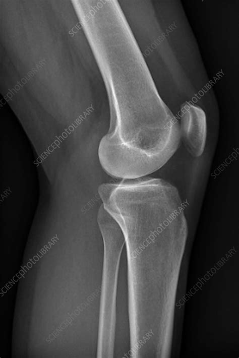 Normal Knee X Ray Stock Image C0147041 Science Photo Library