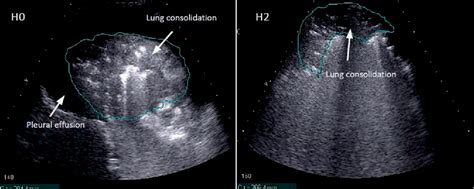 Figure 1 From Ultrasound Assessment Of Lung Consolidation And