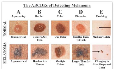How To Detect Melanoma Sourcethe Skin Cancer Foundation Download