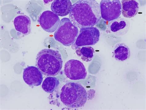 Leucemia Eosinofílica Crónica