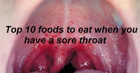 Sore throat treatments may contain either pain relievers, anesthetic agents, antibacterials, natural ingredients with because most sore throats are viral in origin, rest and a good healthy diet help your immune system fight the infection. 10 Foods That Help To Heal A Sore Throat. Save This List ...
