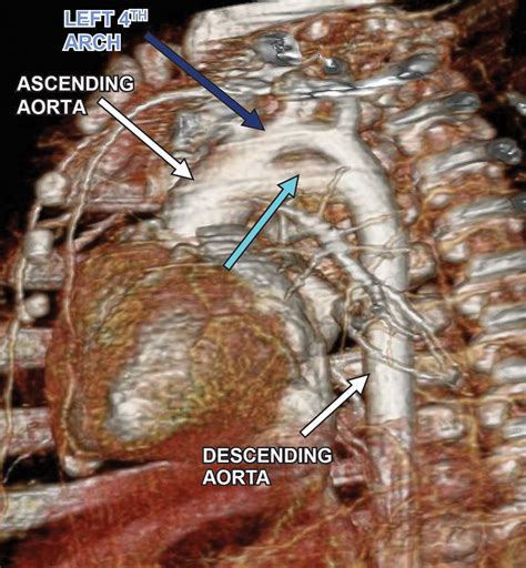 Congenital Variants And Anomalies Of The Aortic Arch Radiographics