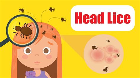 Head Lice What You Need To Know I Health And Nutrition Youtube