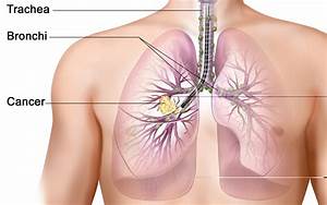 The Connection Between Smoking & Lung Cancer Lung Cancer  