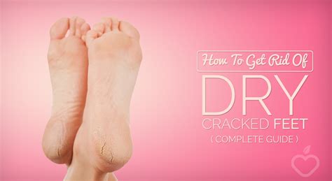 How To Get Rid Of Dry Cracked Feet Guide